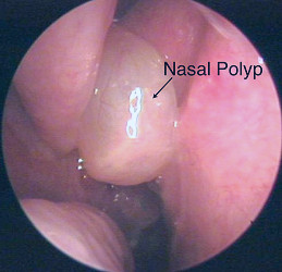Nasal Polyps Treatment - Polyposis Relief - Fort Worth ENT & Sinus